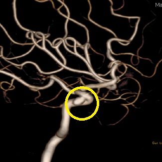 脳動脈瘤に対するコイル塞栓術 術前