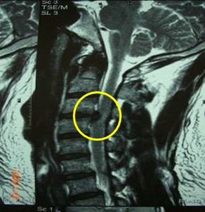 頚椎椎間板ヘルニアのMRI画像