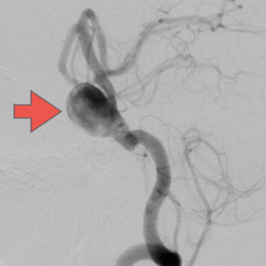 脳底動脈瘤　術前