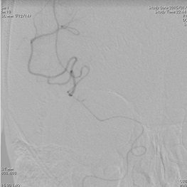 閉塞部遠位までマイクロカテーテルを誘導し造影