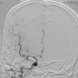 手技開始速やかに完全再開通を得た