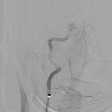 治療前造影で右内頸動脈の完全閉塞を認める