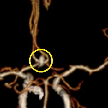 脳動脈瘤に対する頸部クリッピング術 術前