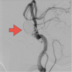 脳底動脈瘤はコイルにより完全に塞栓され、正常の脳底動脈の血流は維持されている。