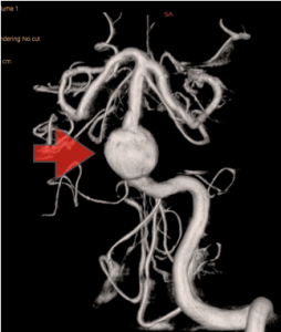 三次元脳血管撮影像