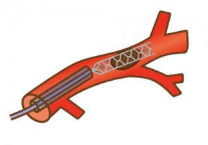 血栓回収療法：ステント型