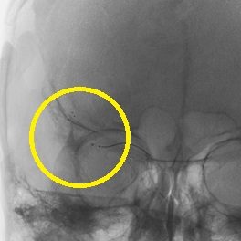 ソリティアを閉塞部まで誘導し展開