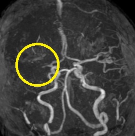 右大脳動脈閉塞