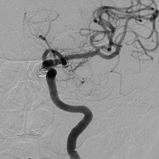 脳動脈瘤に対するコイル塞栓術 術後