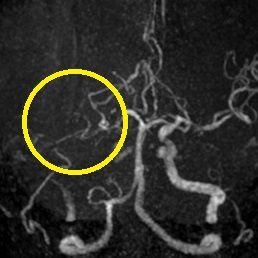 ソリティア(ステント型血栓除去器具)による超急性期血管内治療前