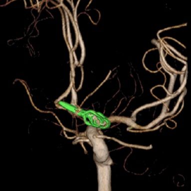 脳動脈瘤に対する頸部クリッピング術