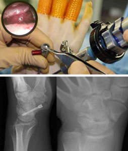 手関節鏡を用いた最小侵襲手術