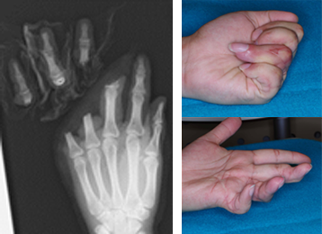 左写真：左中・環・小指完全切断 右写真：術後2年