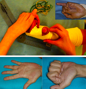 上写真：専門のハンドセラピスト（作業療法士）の指導のもと、リハビリを行っているところです。（右上：左環指屈筋腱損傷） 下写真：術後１年、正常まで回復