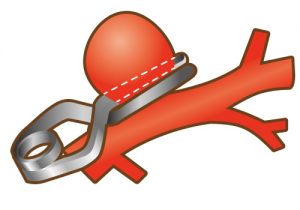 ネッククリッピング術