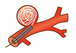 脳動脈瘤コイル塞栓術