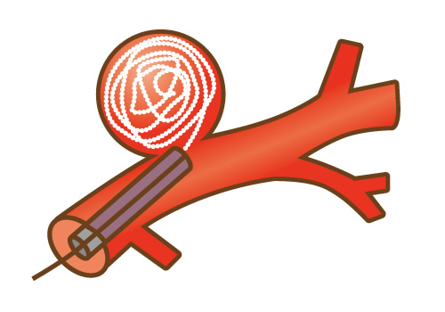 脳動脈瘤コイル塞栓術